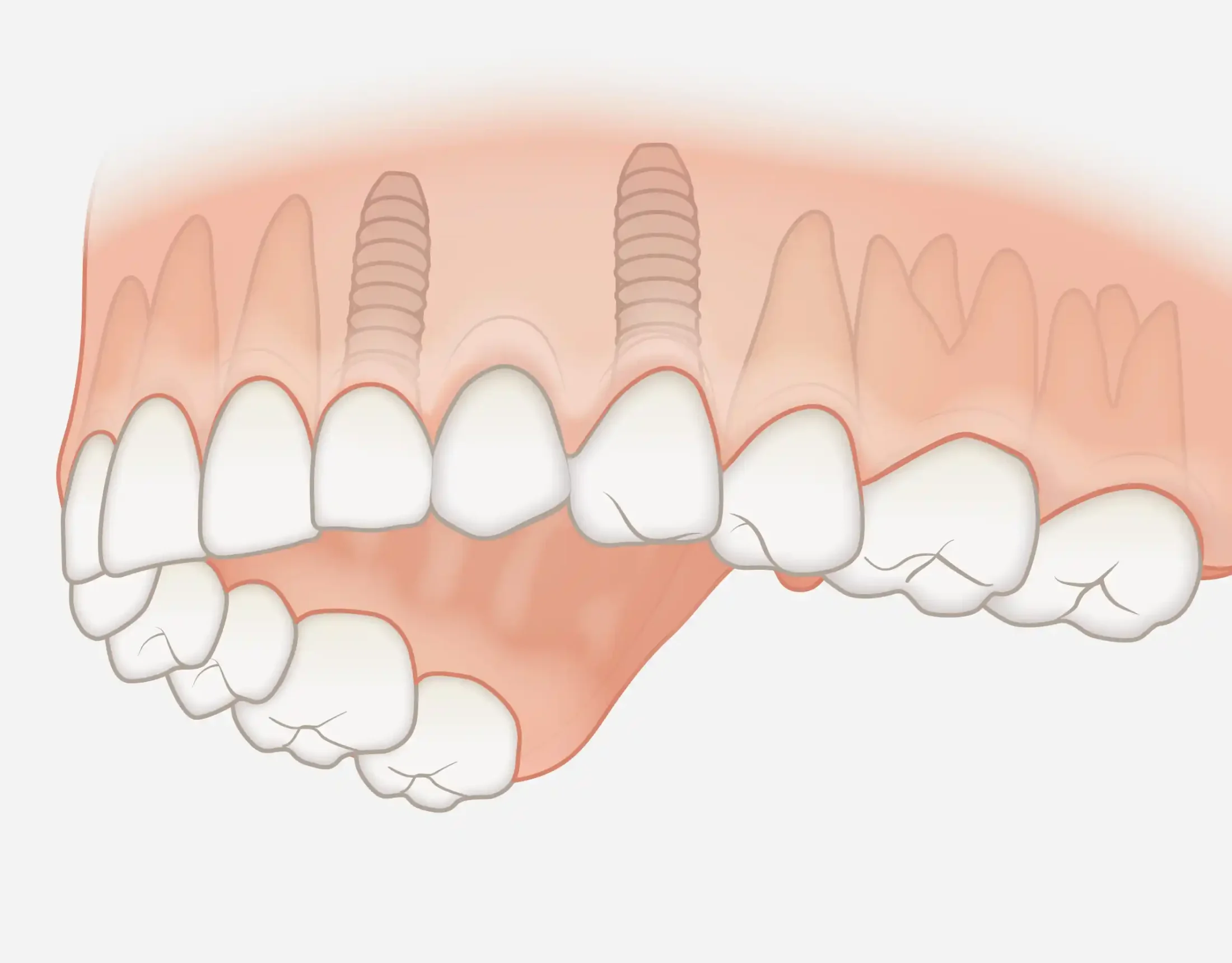 Impianto per gruppo di denti