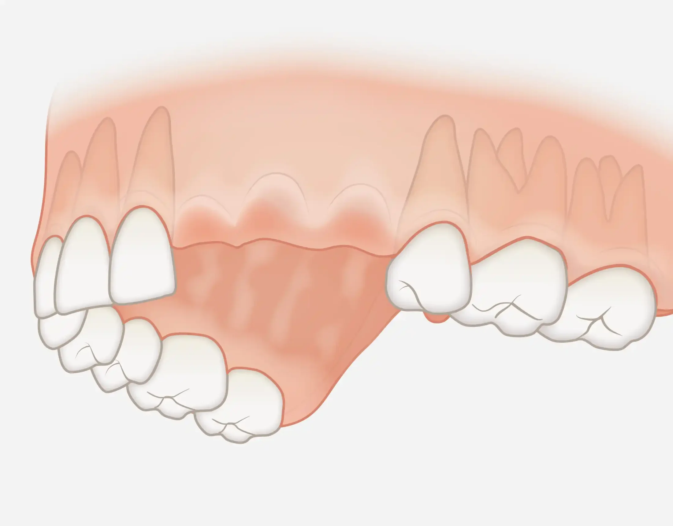 Sostituzione di gruppi di denti