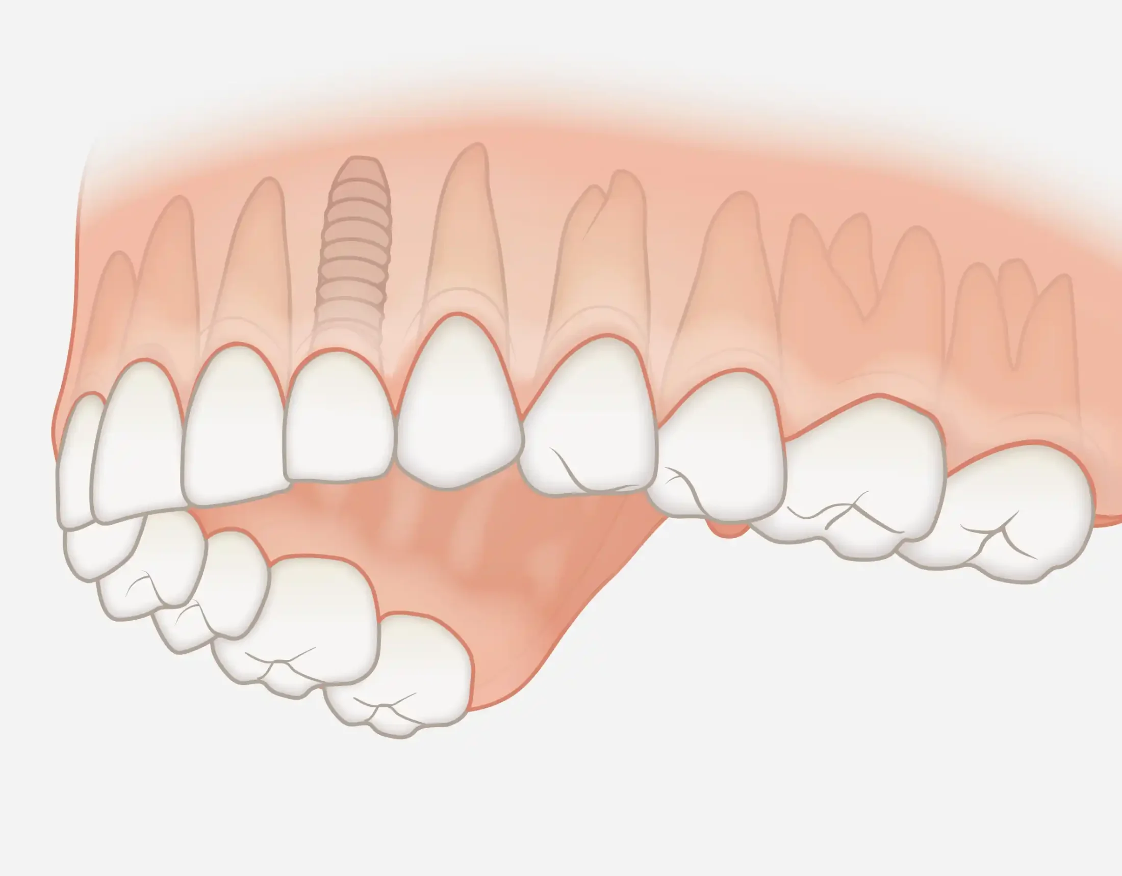 Impianto per singolo dente