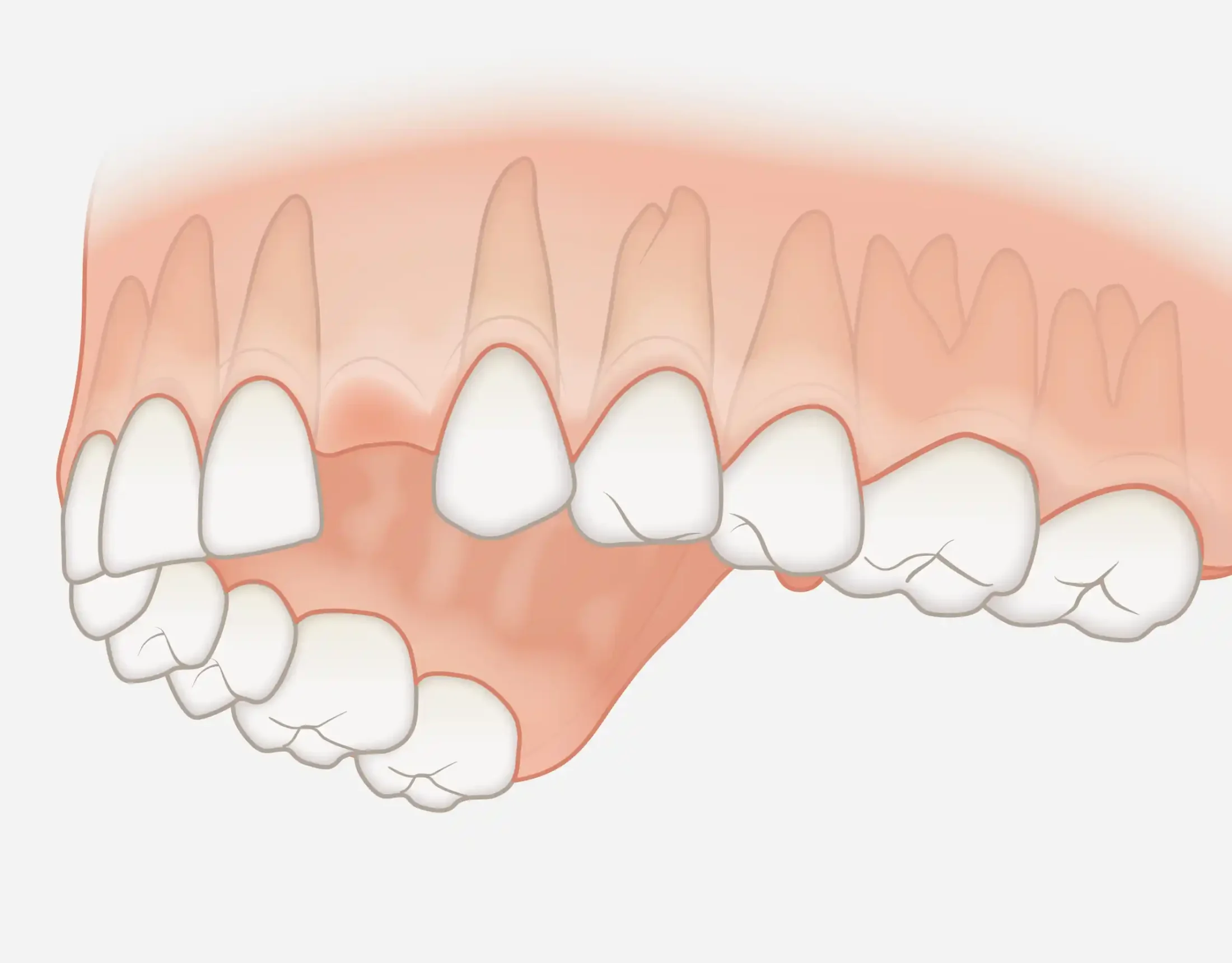 Sostituzione del singolo dente